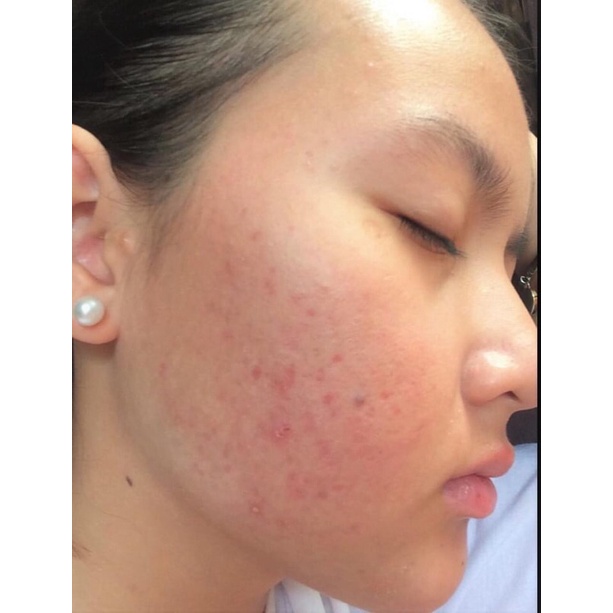 Gel bôi mụn cùng công thức với Differin Adapalene 0.1% dành cho da mụn ẩn mụn mủ viêm mụn đầu đen và da sần sùi | BigBuy360 - bigbuy360.vn