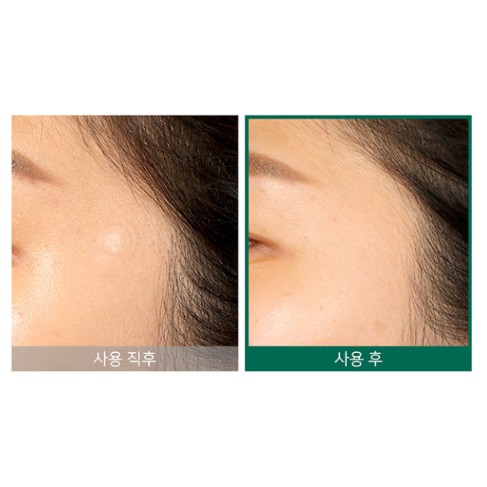 Miếng Dán Hỗ Trợ Giảm Mụn "Thần Kỳ" Some By Mi Clear Spot Patch (Set 18 miếng)