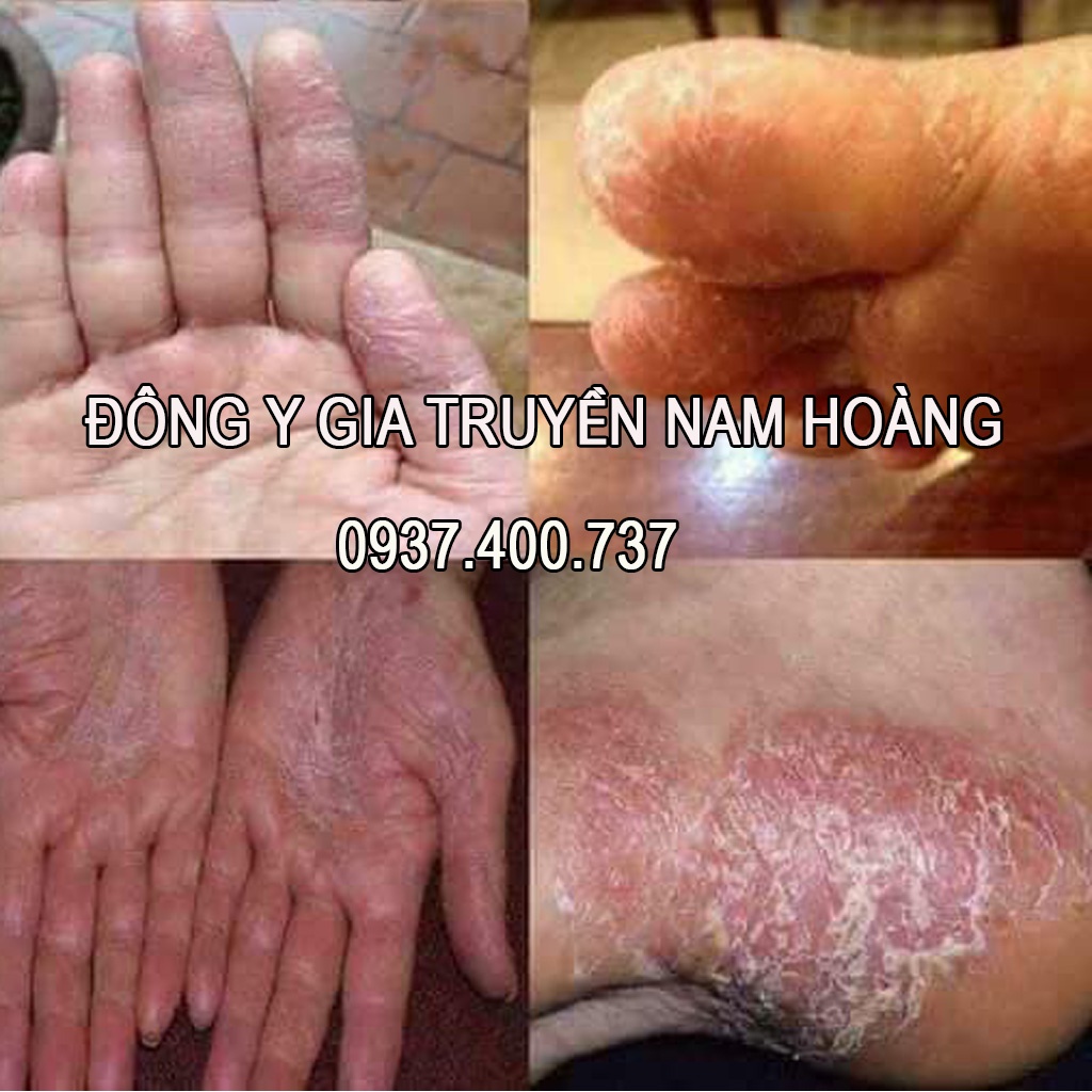 Thuốc_Hỗ_Trợ_Trị_#Hắc_Lào_#Lang_Ben,#Vảy_Nến,#Á_Sừng