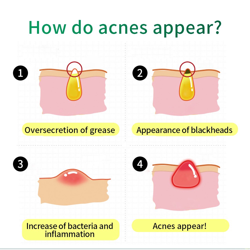 Kem Hỗ Trợ Giảm Pimples Breylee Kiềm Dầu Thu Nhỏ Lỗ Chân Lông 20g / 0.71 floz | BigBuy360 - bigbuy360.vn