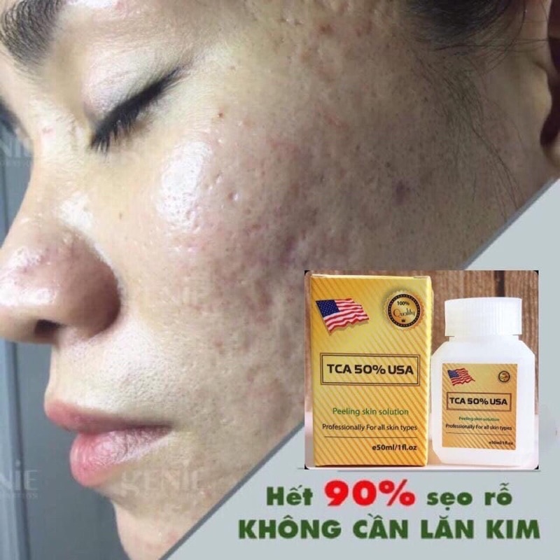 TCA 50% Sạch mụn, Hết rỗ, thâm, nám, lỗ chân lông to, da dầu, rạn, Làm Hồng Ti, peel Nách, bẹn, mông