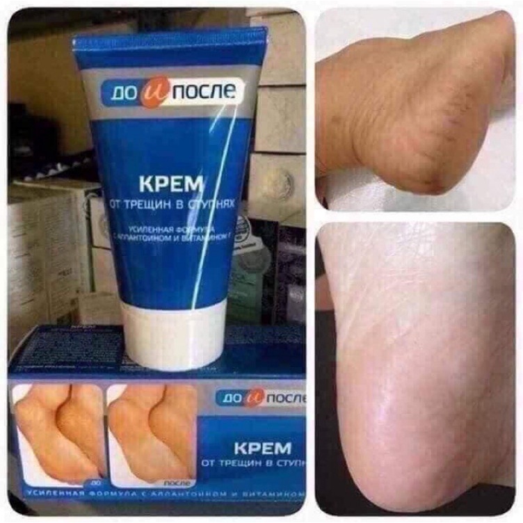 Kem nẻ gót chân Kpem Foot Cream Nga giảm nẻ chân nứt chân khô da chân dưỡng gót chân - [𝐓𝐚̣̆𝐧𝐠 𝐦𝐚́𝐲 𝐦𝐚𝐬𝐬𝐚𝐠𝐞 𝐦𝐚̣̆𝐭]