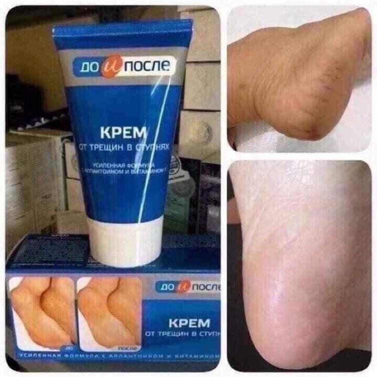 Kem nứt gót chân Kpem Foot Cream Nga giảm nẻ chân nứt chân khô da chân dưỡng gót chân- [𝐓𝐚̣̆𝐧𝐠 𝐦𝐚́𝐲 𝐦𝐚𝐬𝐬𝐚𝐠𝐞 𝐦𝐚̣̆𝐭]