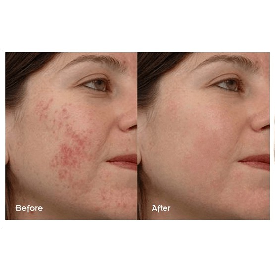 Serum The Ordinary Niacinamide 10% + Zinc 1% Giảm Viêm , Giảm Mụn