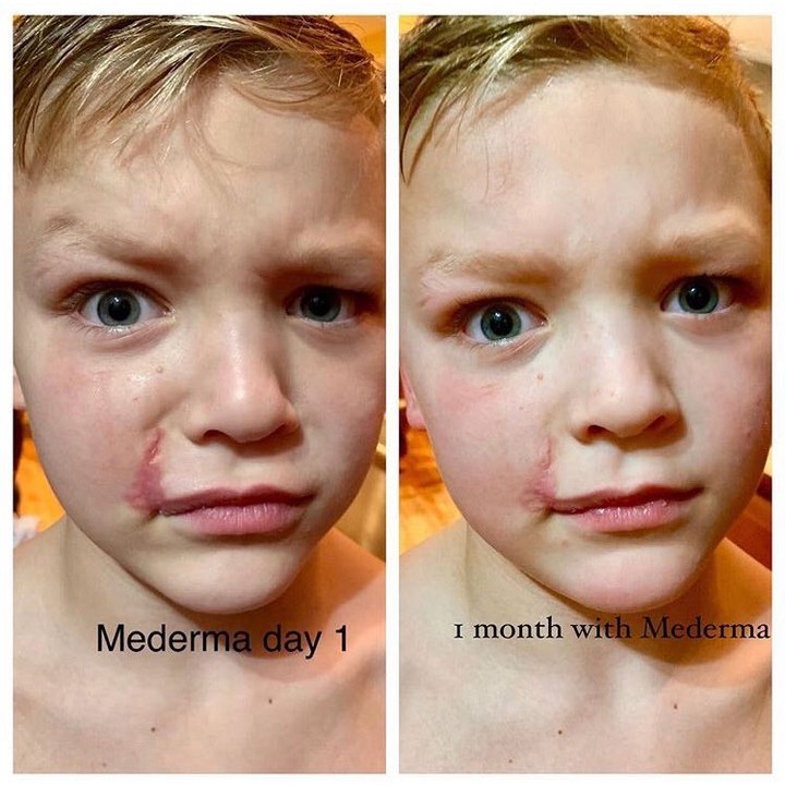 Kem mờ sẹo Mederma Advanced Scar Gel / Scar Cream SPF30 / For Kids (20g)