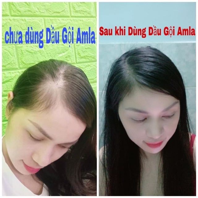 Bộ Dầu gội – Dầu xả – Serum Amla Laco chống rụng kích thích mọc tóc | BigBuy360 - bigbuy360.vn