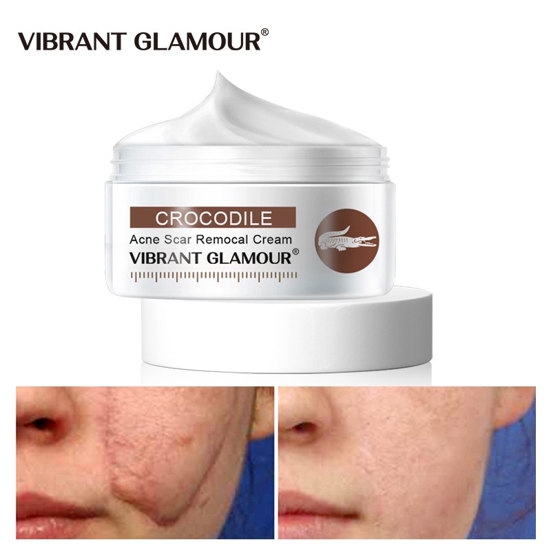 Kem Loại Bỏ Sẹo VIBRANT GLAMOUR Giảm Vết Rạn / Mụn / Đốm Làm Trắng Da Dưỡng Ẩm Chống Nếp Nhăn Không Nhờn Rít 30g