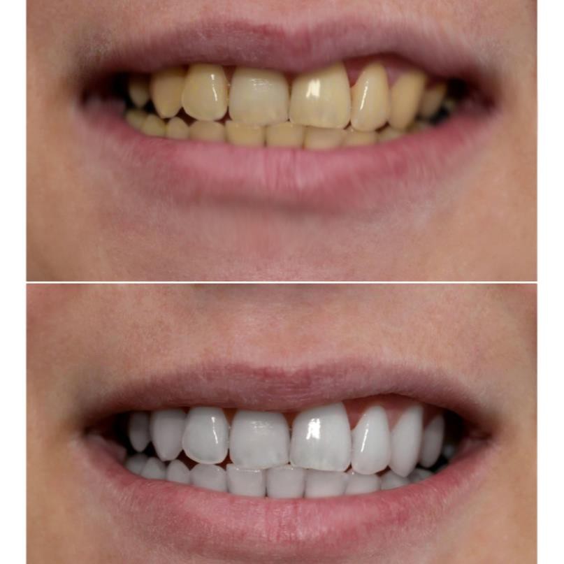 Smilee - Bộ tẩy trắng răng tại nhà tự nhiên, tự làm trắng răng tại nhà an toàn | Made in USA