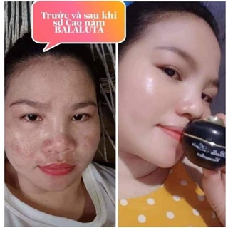 combo Cao Nám Balla Luta chính hãng tặng kèm 1 serum jiuhi