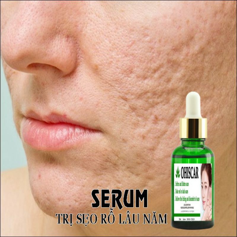 Serum & Kem Hổ Trợ Đầy SẸO RỖ Lâu Năm | BigBuy360 - bigbuy360.vn