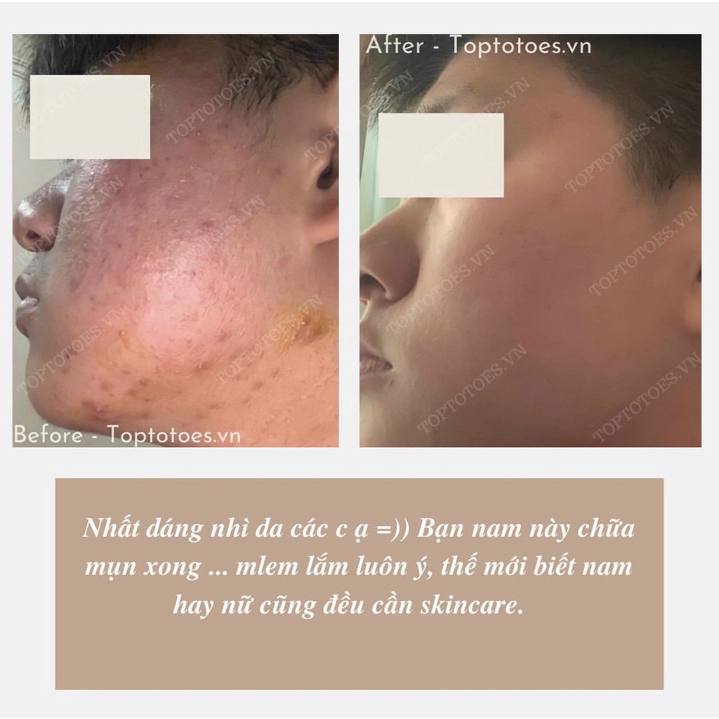 Serum Teana Anti-redness &amp; No Problem 10ml cho da mụn