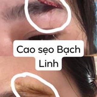 CAO SẸO BÁCH Y SÂM - BẠCH LINH