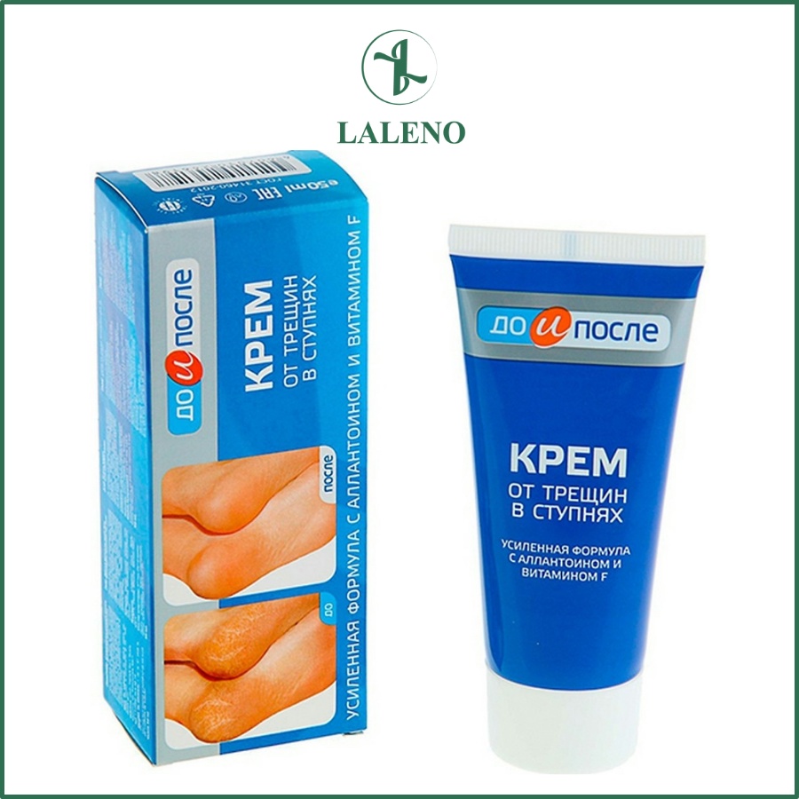 KEM GIẢM NỨT GÓT CHÂN NGA KPEM 50ML