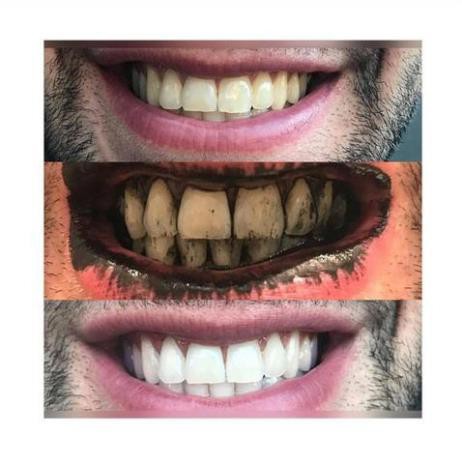 [Combo 2 hộp] Bột trắng răng than tre hoạt tính - Teeth Whitening Nhật Bản (HIỆU QUẢ SAU 7 NGÀY) | LIFE14