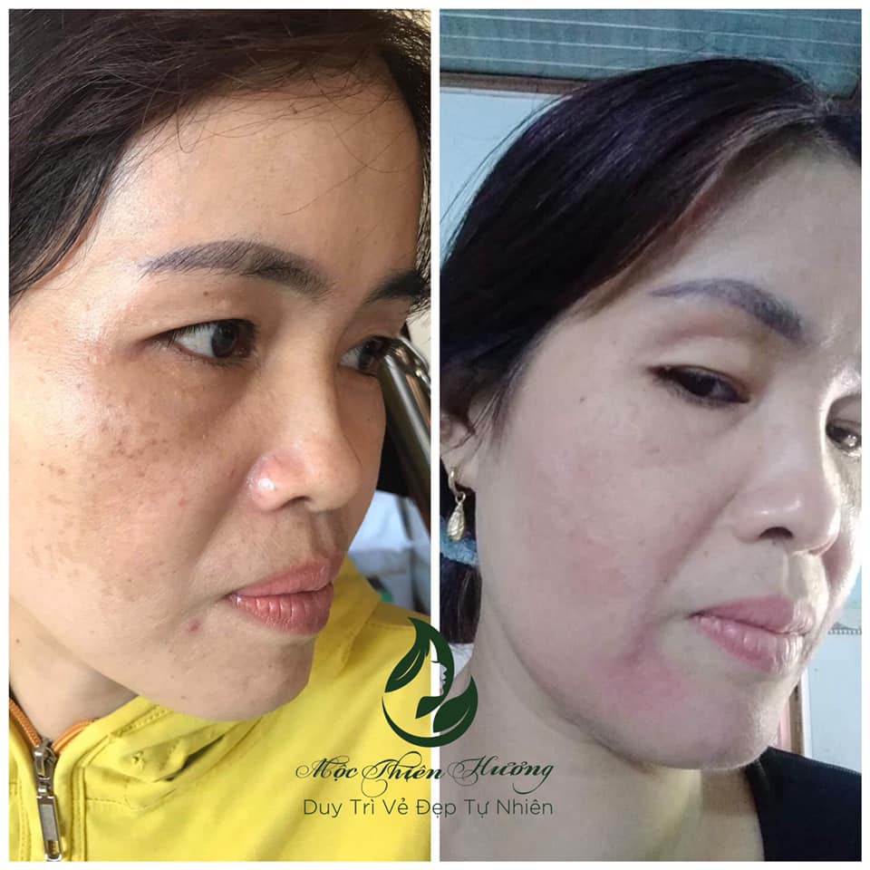 Serum giảm mụn thâm rỗ, sáng da, se khít lỗ chân lông Mộc Thiên Hương 50ml | BigBuy360 - bigbuy360.vn