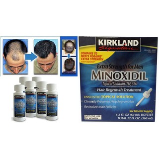 Minoxidil 5% - Thuốc mọc râu cho nam giới