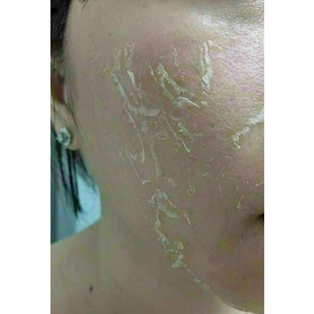 Peel da vi tảo/ thay da sinh học cho mặt, nách, lưng Hanmade