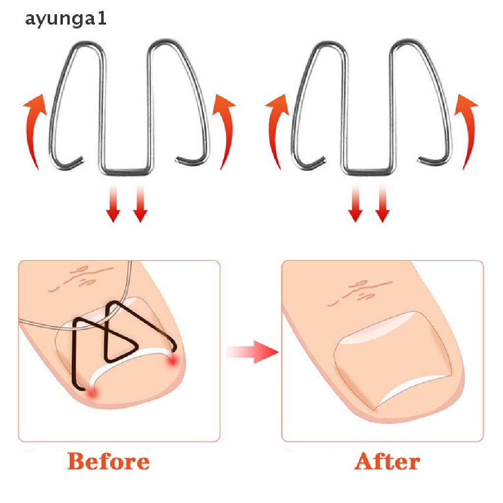 [ayunga1] Nail Art Ingrown Toe Nail Correction Tool Toenail Nail Orthosis Paronychia Clip [new]