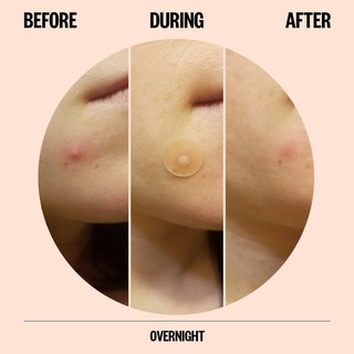 Miếng dán mụn Peace Out Acne Healing Dots (gói 6 miếng)