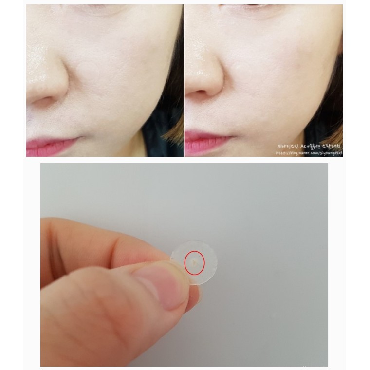 Miếng Dán Hút Mụn Trong Suốt, Chống Nước Suốt 24h G9Skin AC Solution Clear Spot Patch