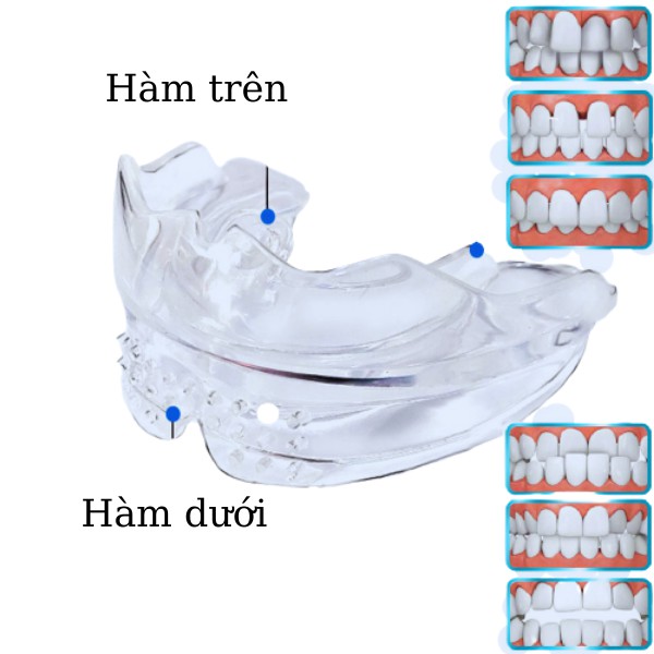 [Niềng răng 4D] Bộ niềng răng tại nhà cho trẻ em từ 7 đến 12 tuổi| ALIGNMENT TRAINER trong suốt|định hình răng cho bé