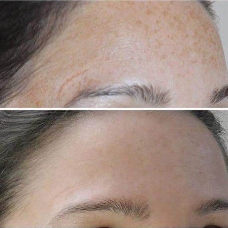 Serum thần thánh Neoretin discrom control booster fuild phục hồi làn da - Chính hãng