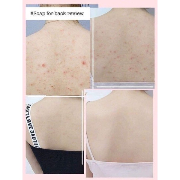 Xà phòng mụn lưng for back nội địa (air)