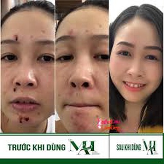 Thảo dược làm sạch mụn, lựa chọn hoàn hảo cho làn da mụn