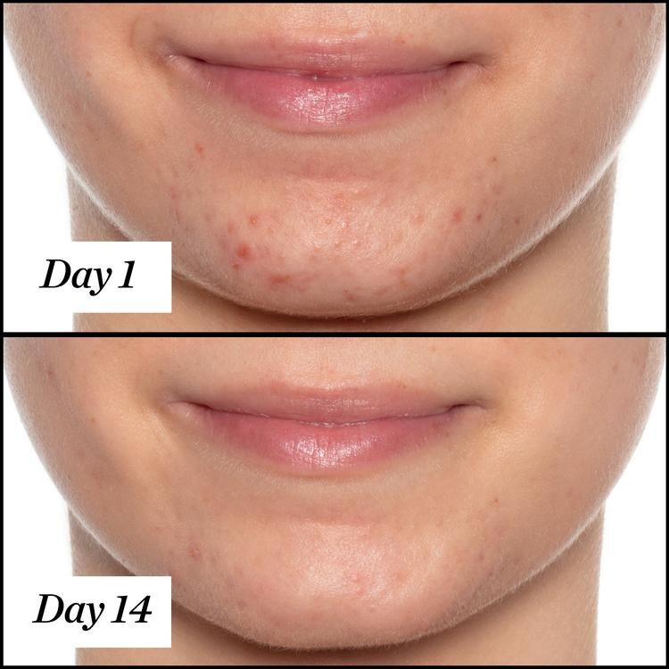 [Sale Nghỉ Bán] Dầu dưỡng da loại bỏ mụn Sunday Riley U.F.O Ultra Clarifying Face Oil