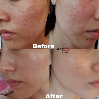 Tinh Chất Giảm Mụn Lumos Acne 5ml