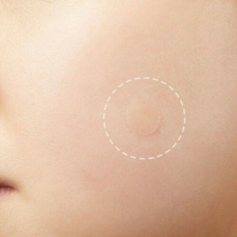 36/72pcs Invisible Skin Acne Patch Hydrocolloid Tag Skin Care Remover Sticker-RO