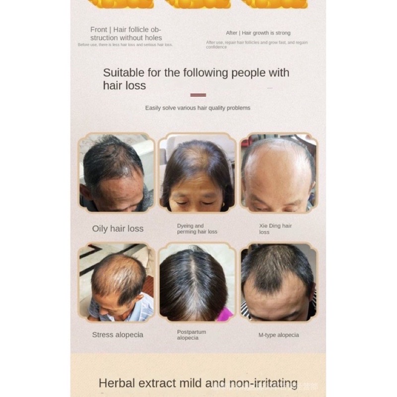 TONGRENTANG – BỘ DẦU GỘI VÀ XỊT SIÊU MỌC TÓC, DÀY TÓC, ĐEN TÓC