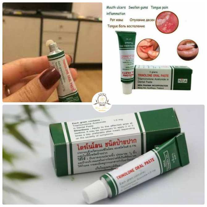 Kem loại bỏ hết nhiệt miệng Trinolone Oral Paste Thái Lan. 100% hàng chính hãng