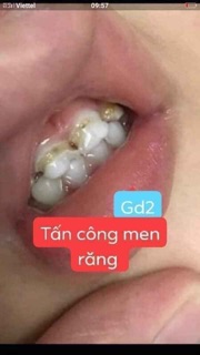 Thảo dược về răng miệng Lợi An