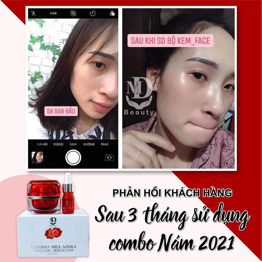 Kem Face Nám Lựu Đỏ MD - Combo Melasma Loại Bỏ Thâm Nám Tàn Nhang [Chính Hãng] | BigBuy360 - bigbuy360.vn