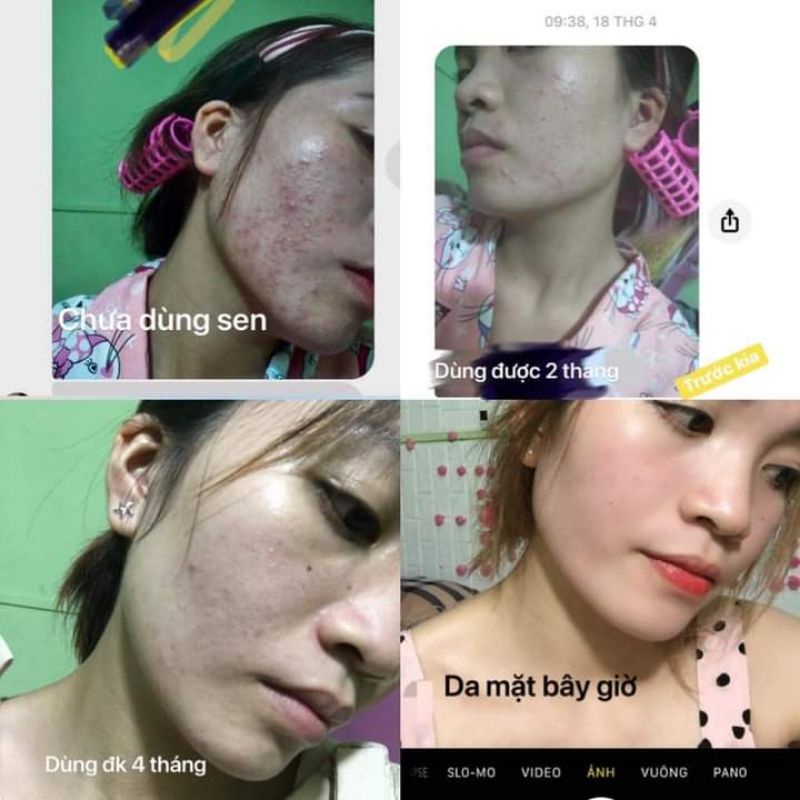 Combo Serum Thảo Dược + Bột Thảo Mộc Sen Spa Mẫu Mới