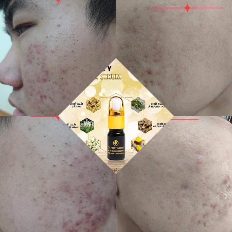 Serum Acne Super serum plus Giảm Mụn-Se khít lỗ chân lông-phục hồi da 5ml.