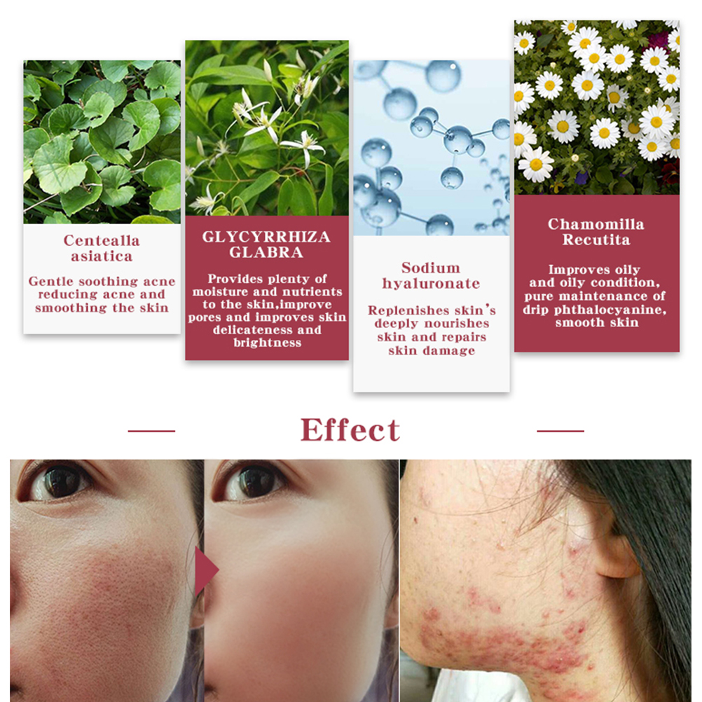 COD 10ml Centella Asiatica Acne Essence Hydrating Anti-Inflammatory Control Oil Pimples Removal Liquid Essence