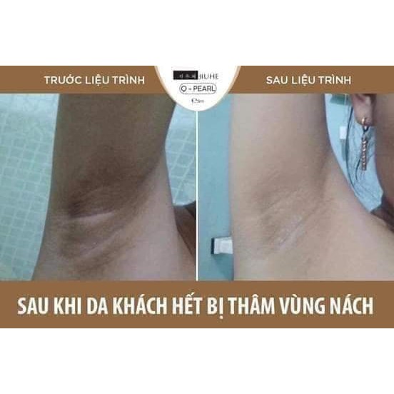 Thâm mụn,Serum Hàn Quốc JIUHE Q-PEARL loại bỏ thâm do mụn khuỷu tay chân, thâm sẹo, thâm nách hiệu quả