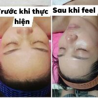 DBH peel bí đỏ 30ml