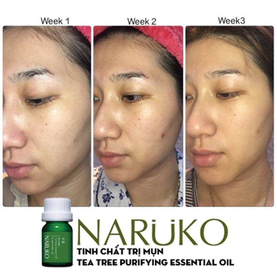 Tinh dầu ngừa mụn Naruko Trà Tràm  giảm mụn viêm  mụn mủ ,kiềm dầu , kháng khuẩn 10ml (Bản Đài)