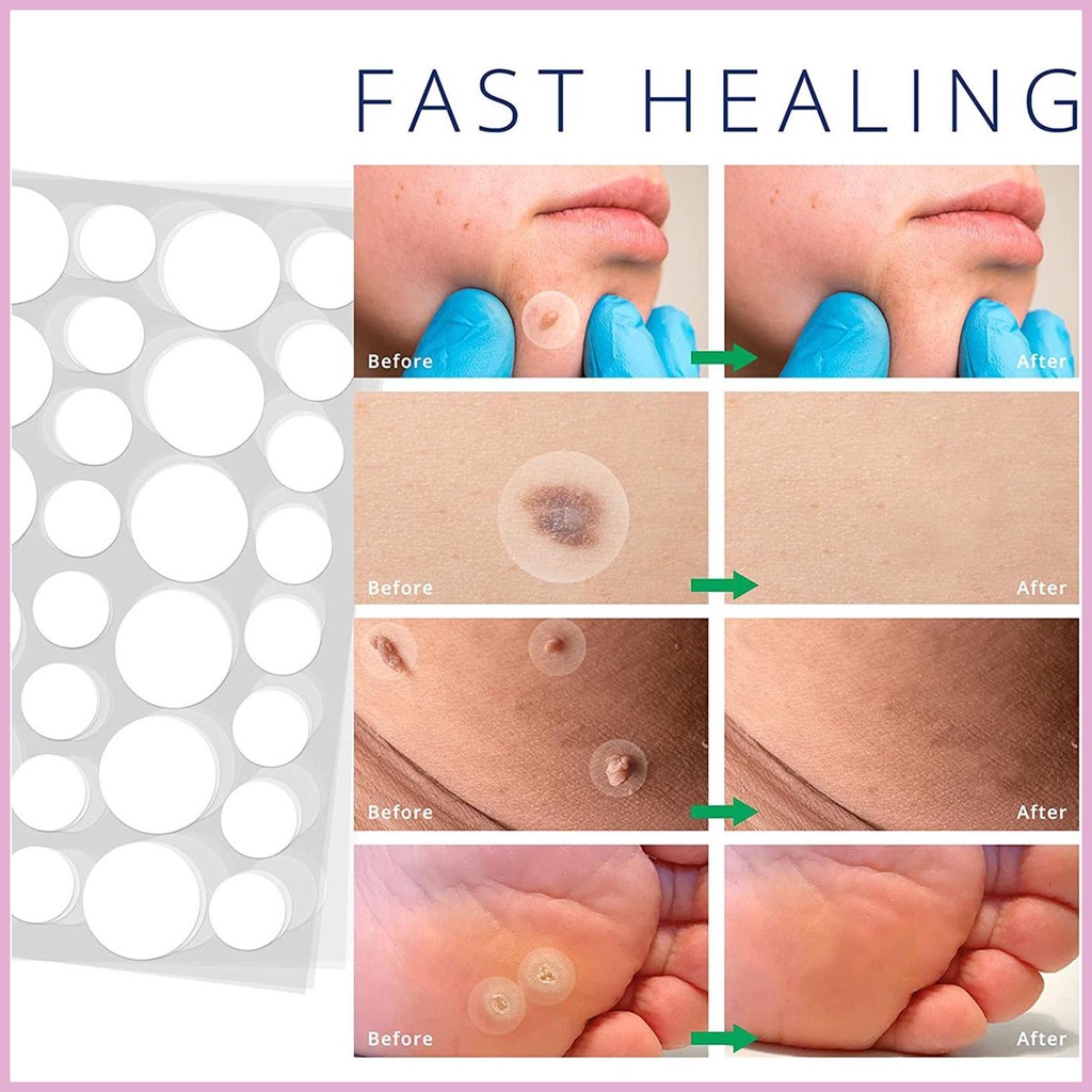Gel Hydrocolloid Tẩy Mụn Thịt Dư Trên Mặt Và Cơ Thể An Toàn