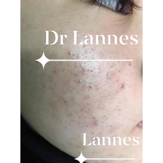 Serum mụn Dr.lannes[Tặng cây nặn mụn]