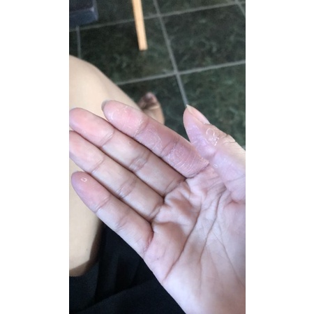 Chàm da,  Bong Tróc da,Ngứa da bàn tay