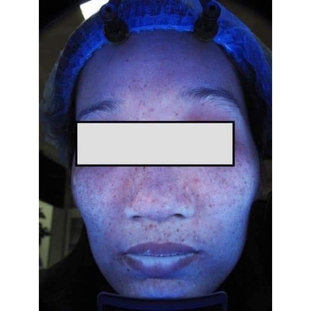 Đèn wood soi da dùng trong spa thẫm mỹ viện