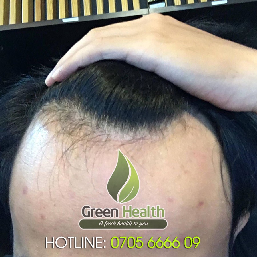 Hộp 6 chai Minoxidil 5% dạng BỌT  mọc râu tóc