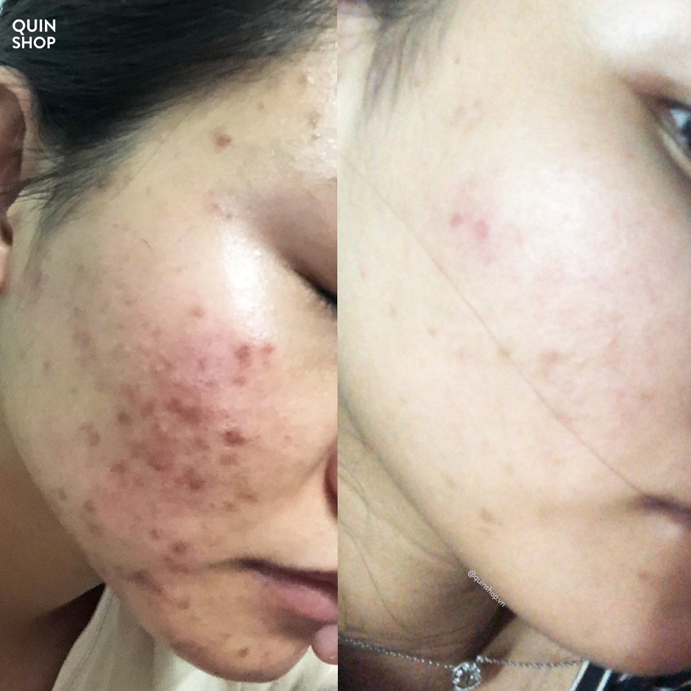 Tinh Chất Tái Tạo Da The Ordinary AHA 30%+BHA2% Peeling Solution