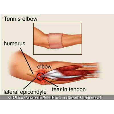 Đai bó cơ khuỷu tay khi chơi Tennis, golf, cầu lông, bóng bàn AOLIKES - Tennis Elbow