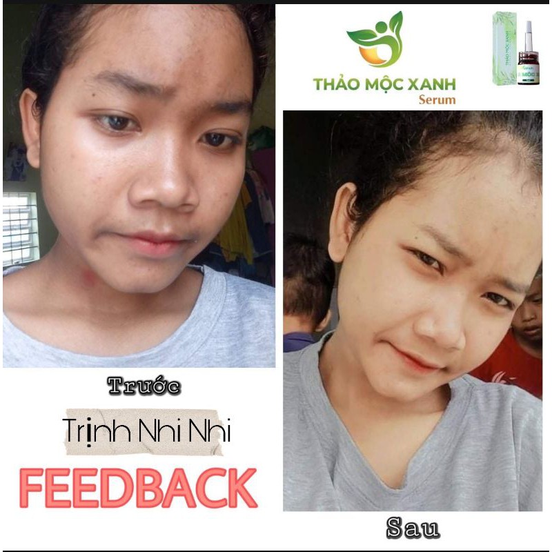 [ CHÍNH HÃNG] SERUM THẢO MỘC XANH