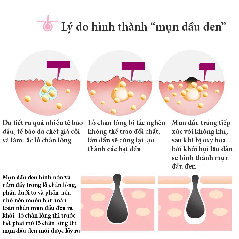 Máy hút mụn , máy hút mụn đầu đen, cám có đầu massage nhiệt tặng 5 đầu hút